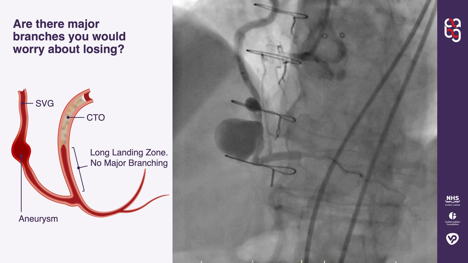 Angio plus illustration