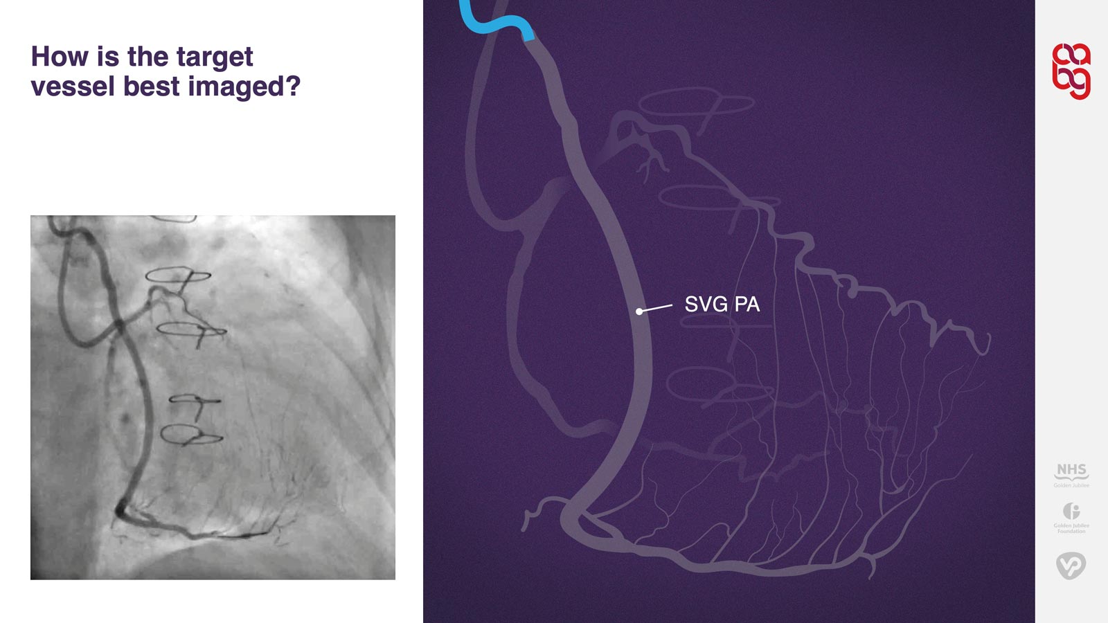 Angio plus illustration